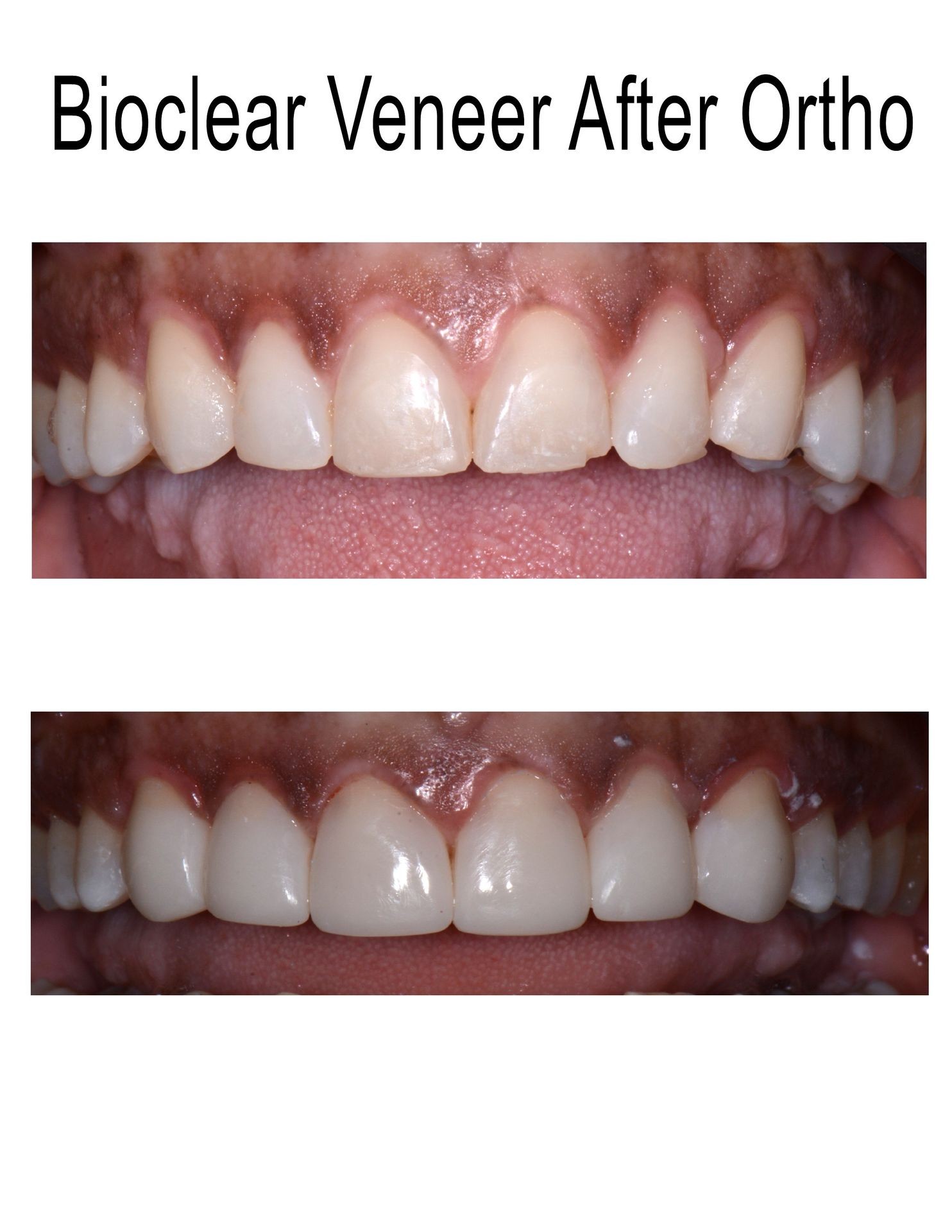 BioClear Veneers