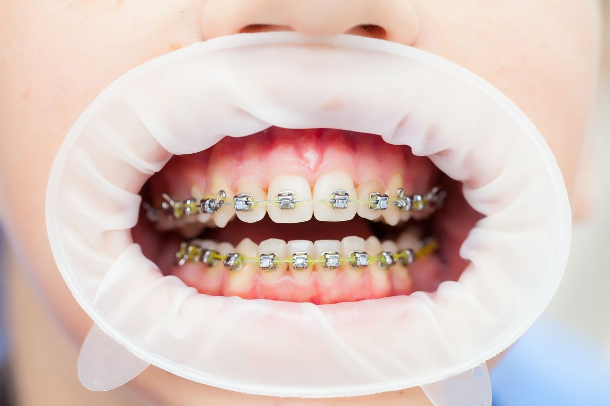 Closeup of young woman's teeth with braces and retractor for mouth. Patient at the dentist