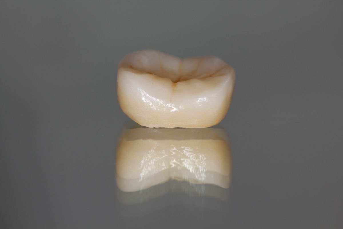 Same-Day Crowns example 3