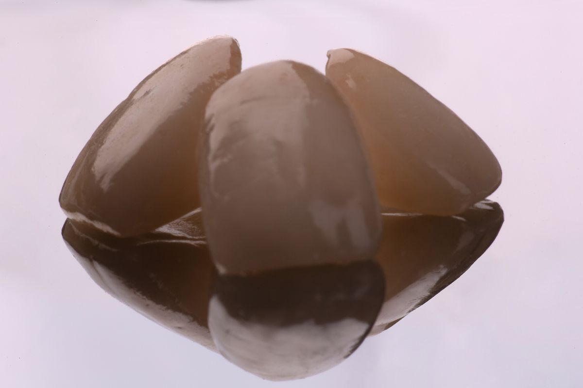 Same-Day Crowns example 4